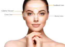 BOTOX-Treatment-Areas